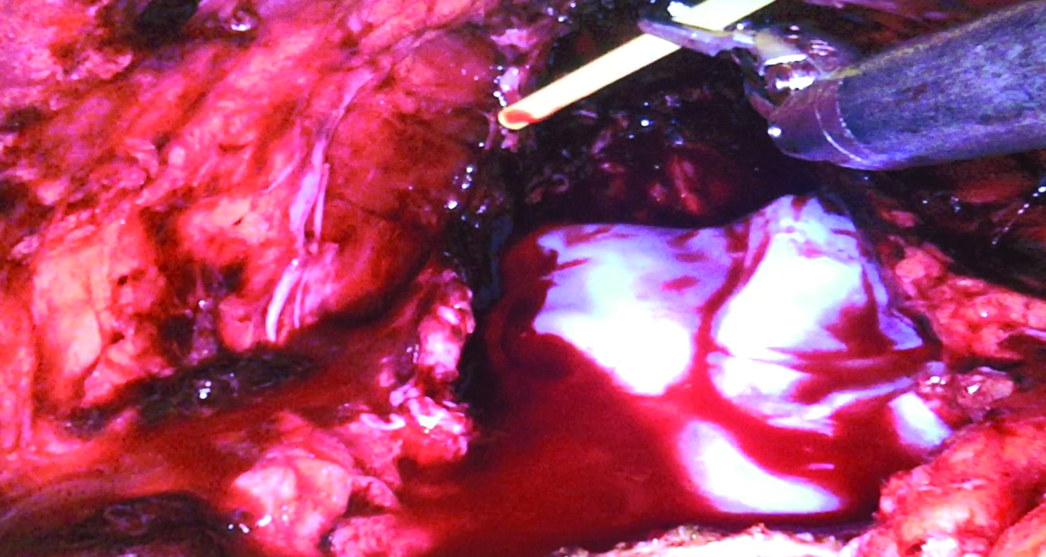 Approximately 0.5 cc of fibrin sealant was applied to the left bundle using a flexible applicator tip.