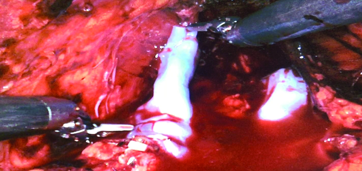 Applied STRAVIX Tissue to the left bundle