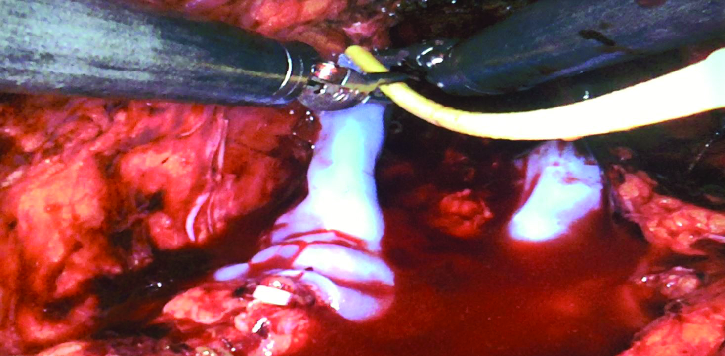 After holding STRAVIX Tissue in place for approximately 10 seconds, an additional 0.5 cc of sealant was applied on top of the graft.