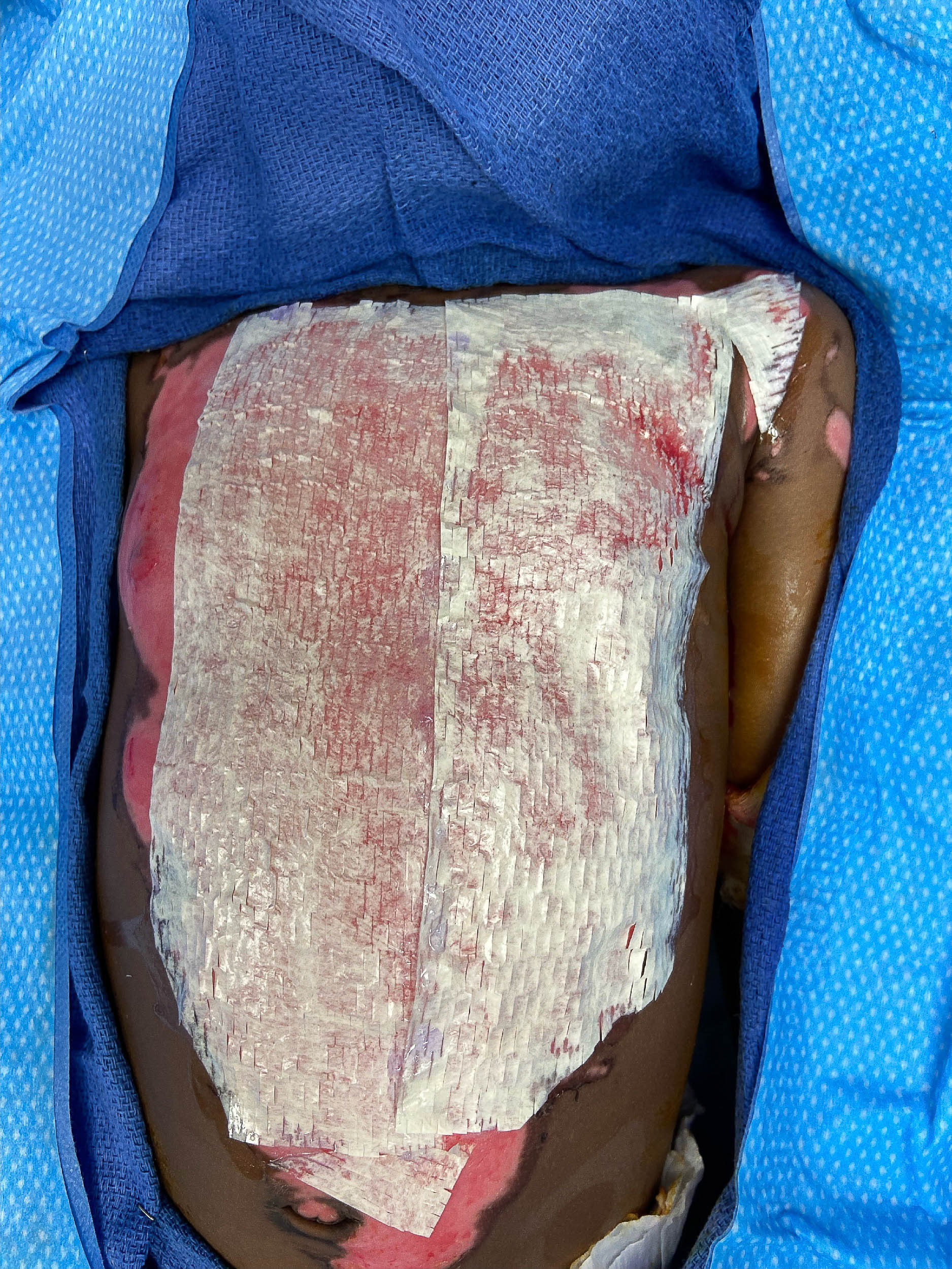 Post burn day 6. Intra-op application of OASIS Burn