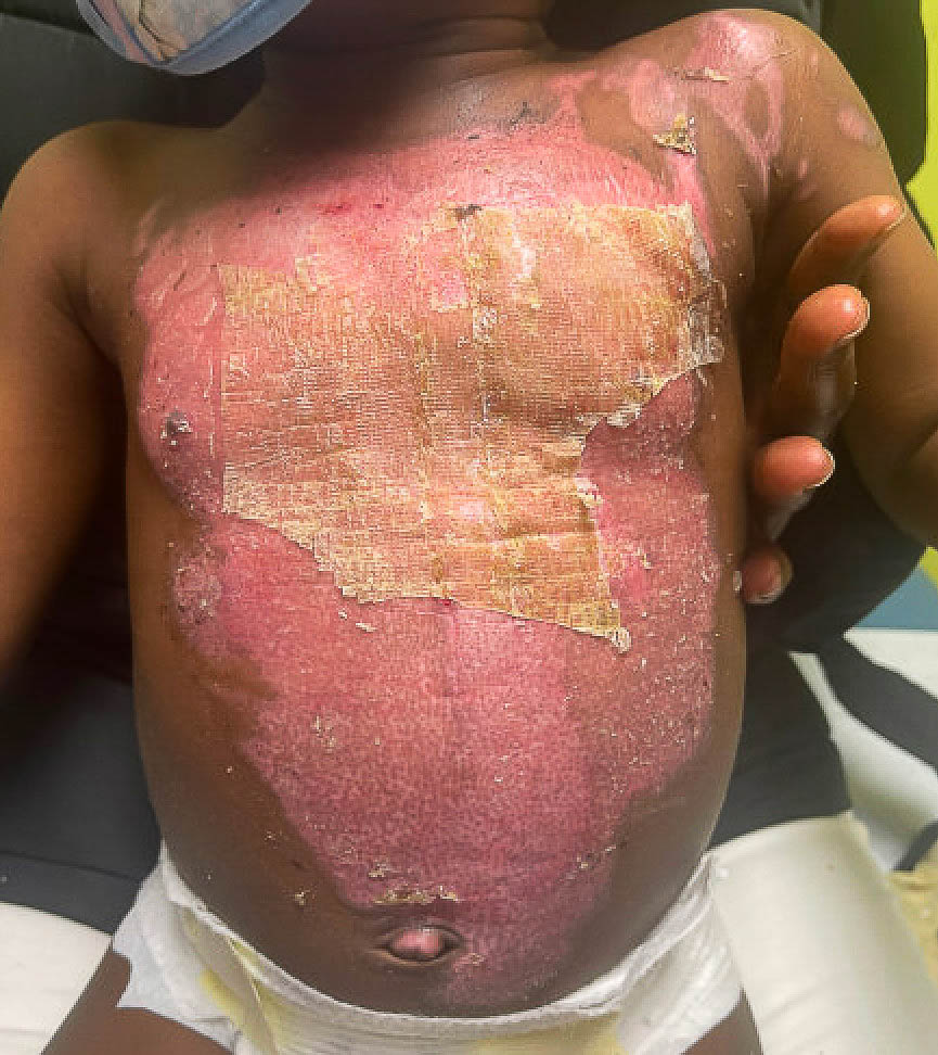 Post application day 7