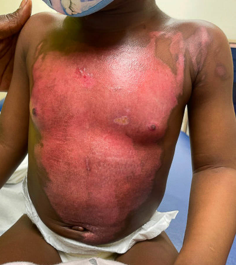 Post application day 14