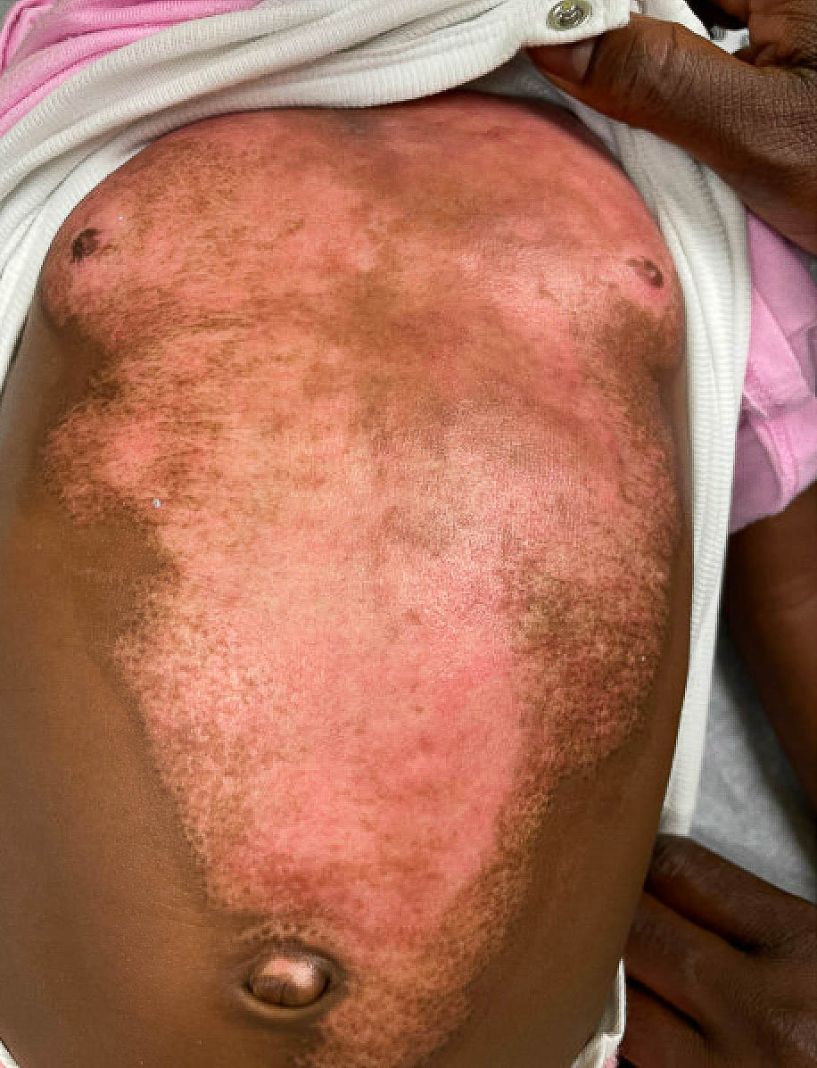 Patient healed in 42 days post single application