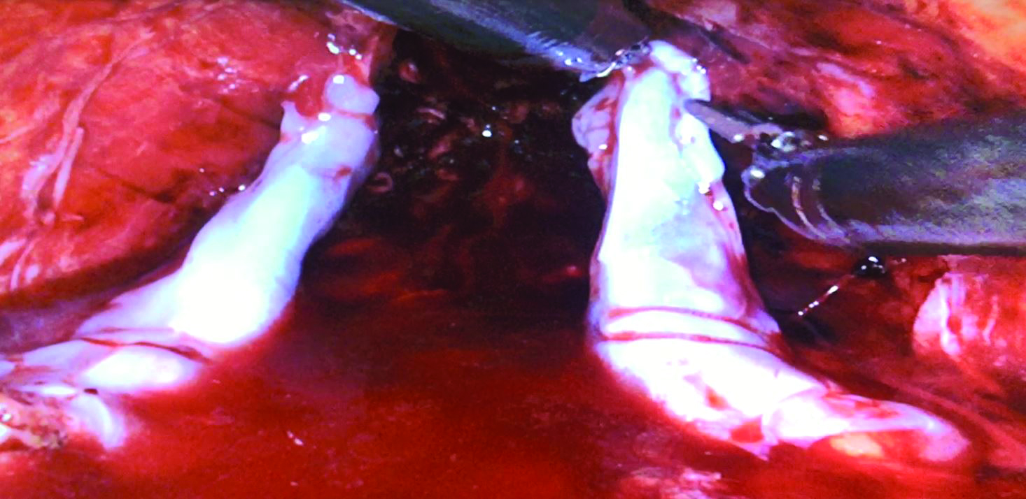 Repeated to cover the right bundle. In total, the application of STRAVIX Tissue added 5 minutes to the total procedure time.