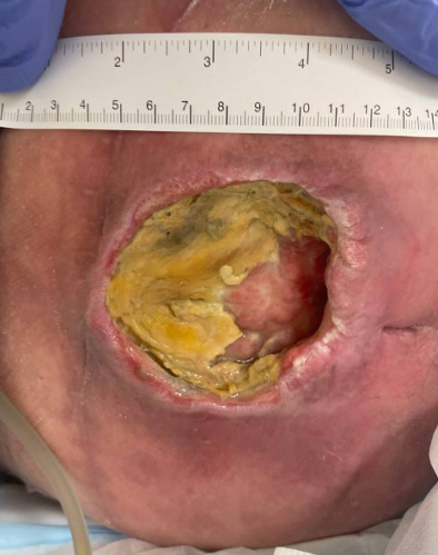 First Clinic visit: 8 Months after failed flap procedure