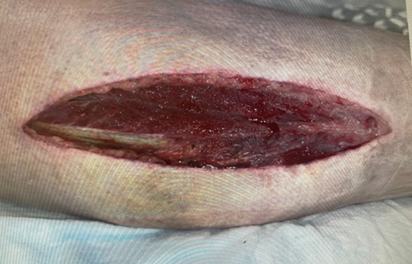 1 week post fasciotomy and NPWT