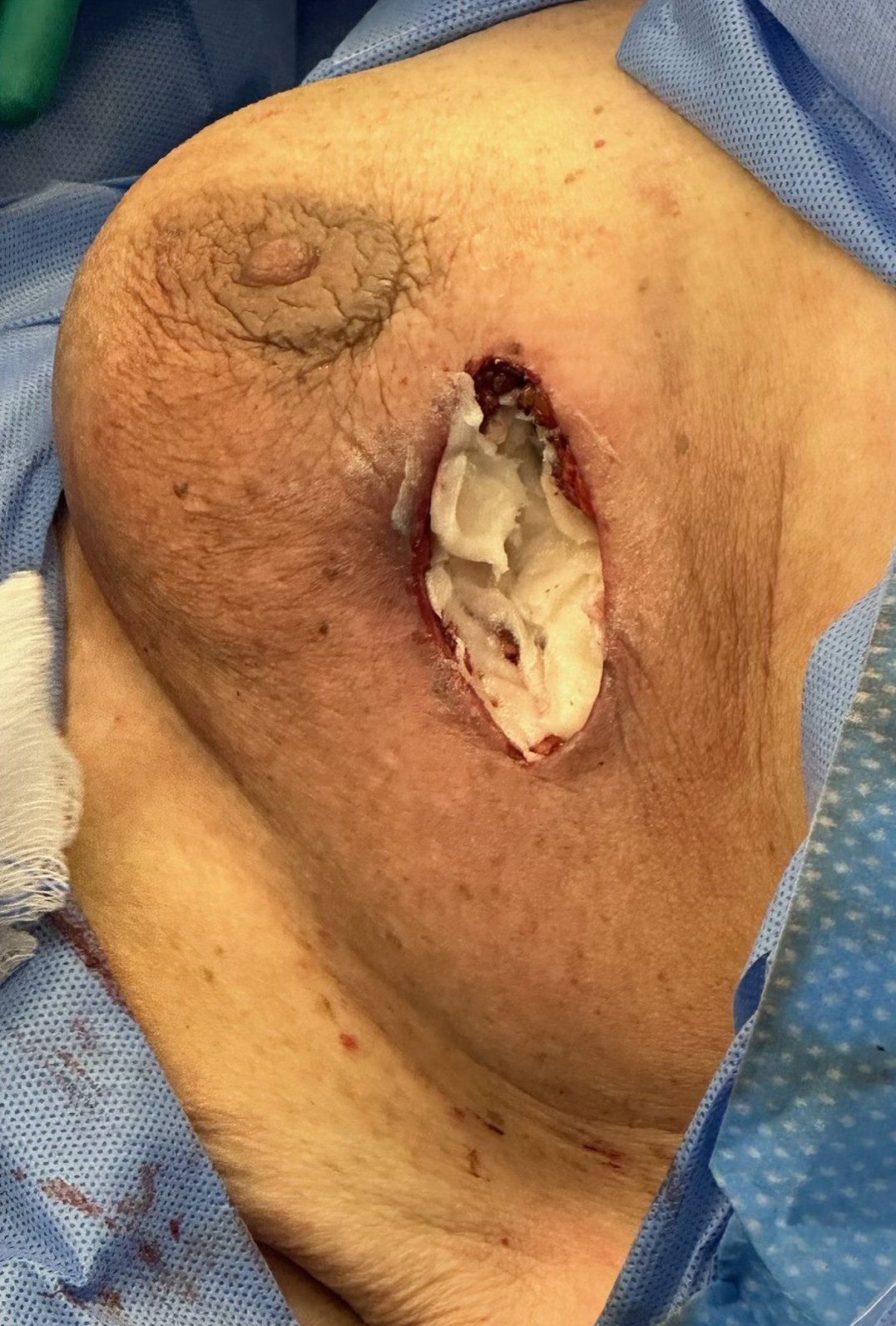 Post-debridement: OASIS® MICRO Micronized Wound Matrix