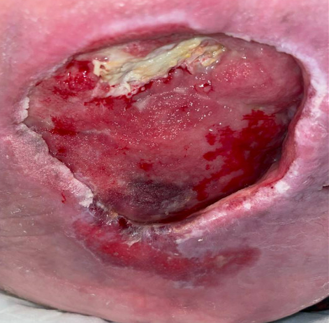 2 months of debridement and IODOSORB Cadexomer Iodine