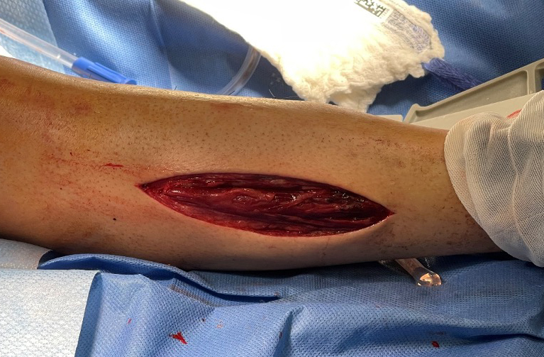 OR visit 1 week post fasciotomy