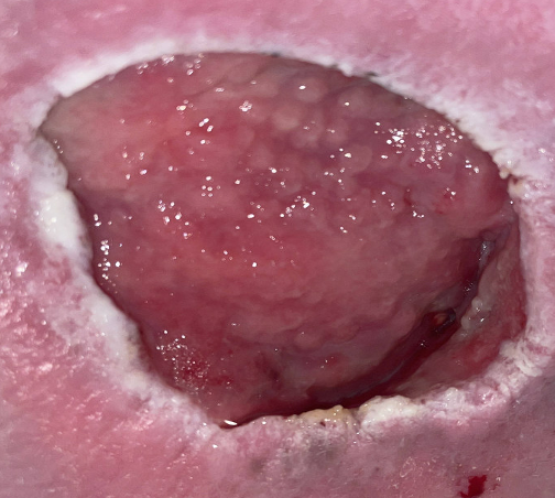 2 weeks before STRAVIX PL Tissue