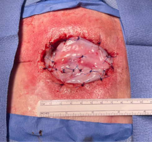 STRAVIX PL Tissue Intra-op