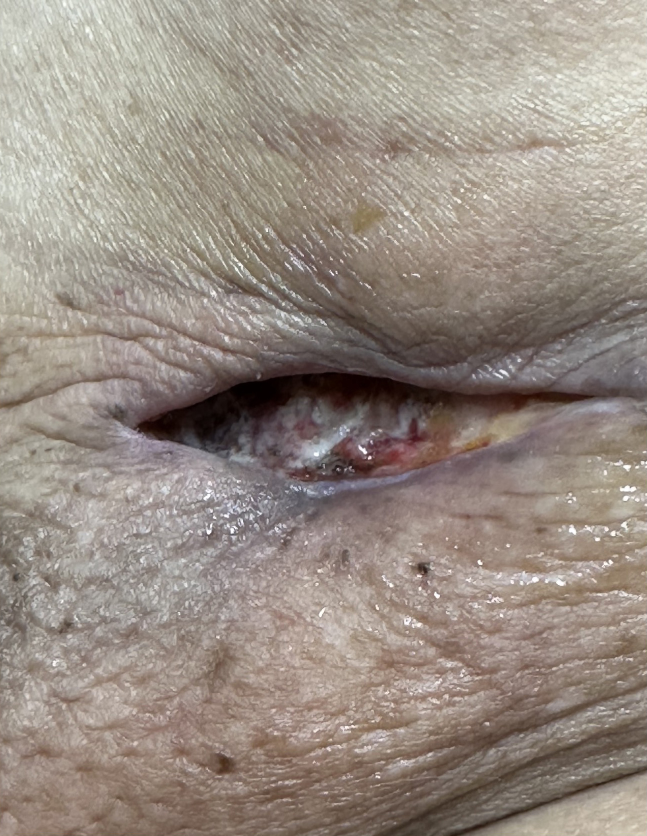 6 days after 2nd application of OASIS MICRO Micronized Wound Matrix