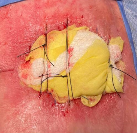 Bolster of Xeroform™ and 4x4 gauze sutured in place with nylon