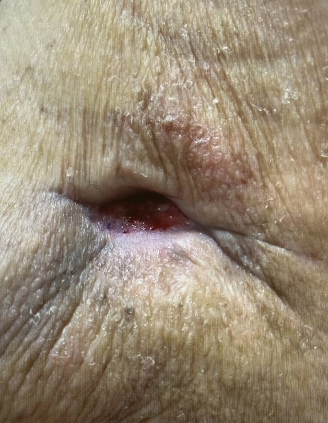 Improved granulation and contracting after 3 applications of OASIS®