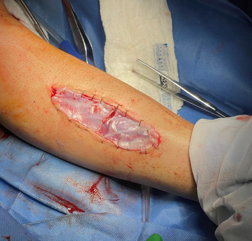 STRAVIX Tissue affixed with staples
