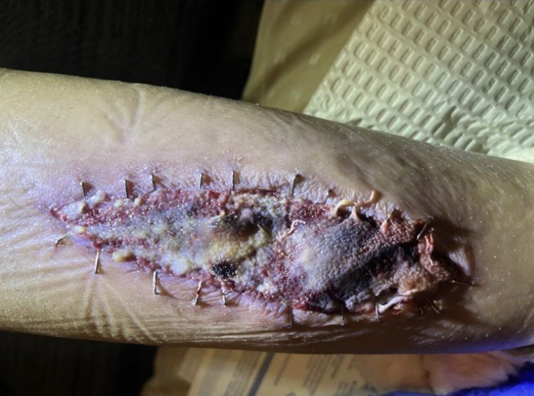 2 weeks post STRAVIX Tissue application. Typical caramelization noted; no clinical signs of infection. Rapid formation of granulation tissue, and size reduction. 