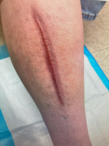 Closure: 5 months post STRAVIX Tissue application