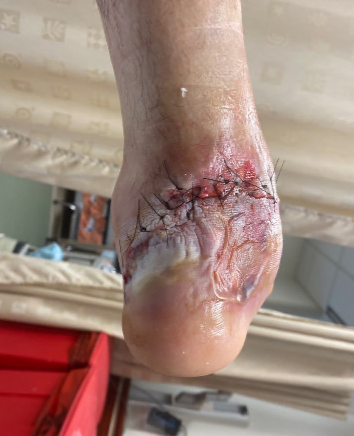6 days after initial debridement