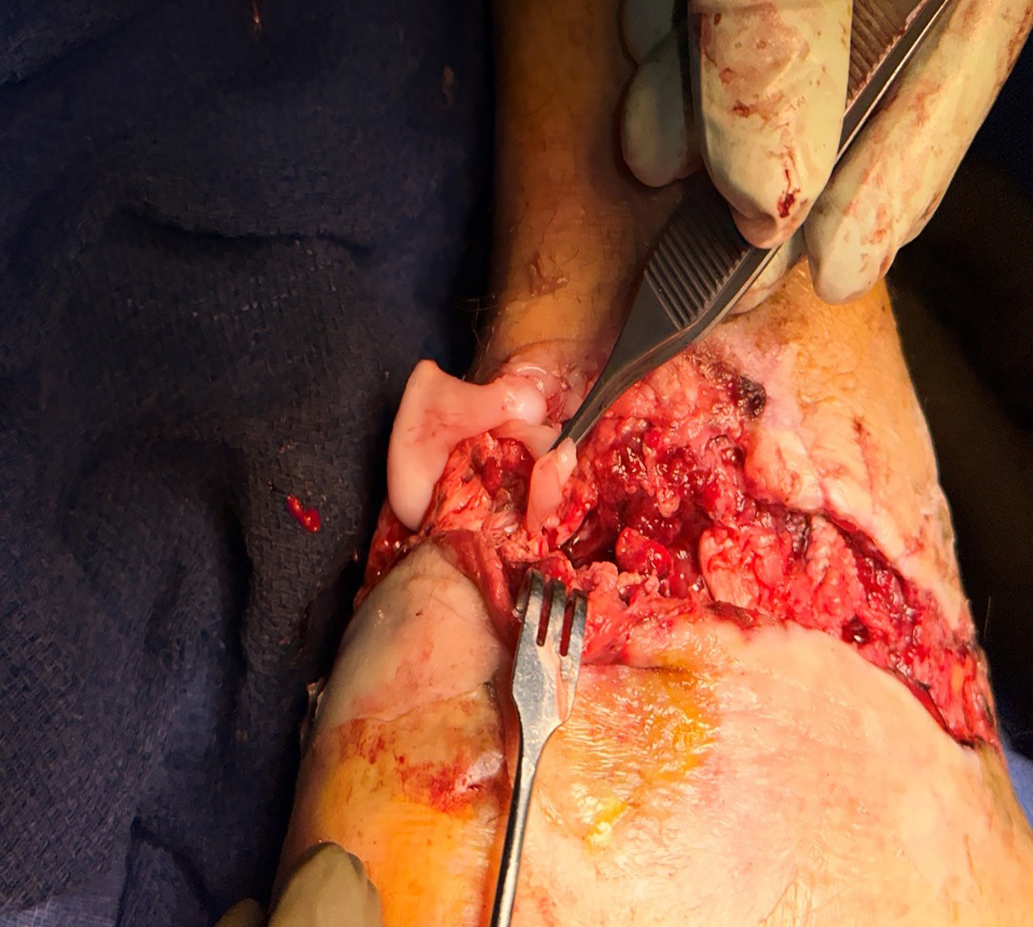 Intraop: status post injury fixation; 10 days after initial presentation and 1 prior debridement
