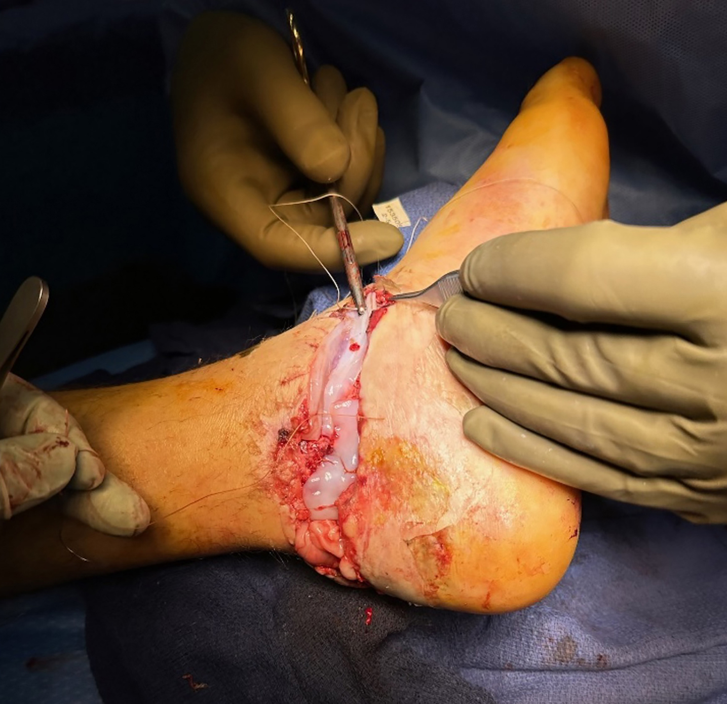 Intraoperative STRAVIX◊ Tissue application