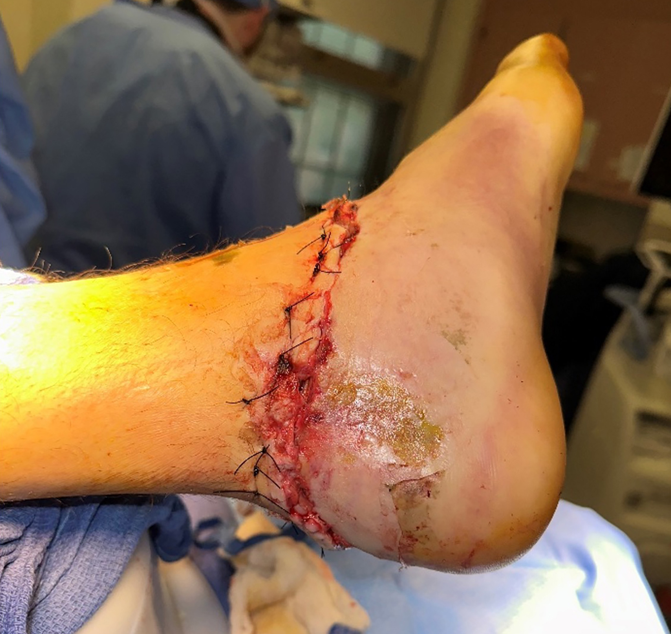 Final closure 3-0 Nylon horizontal mattress​