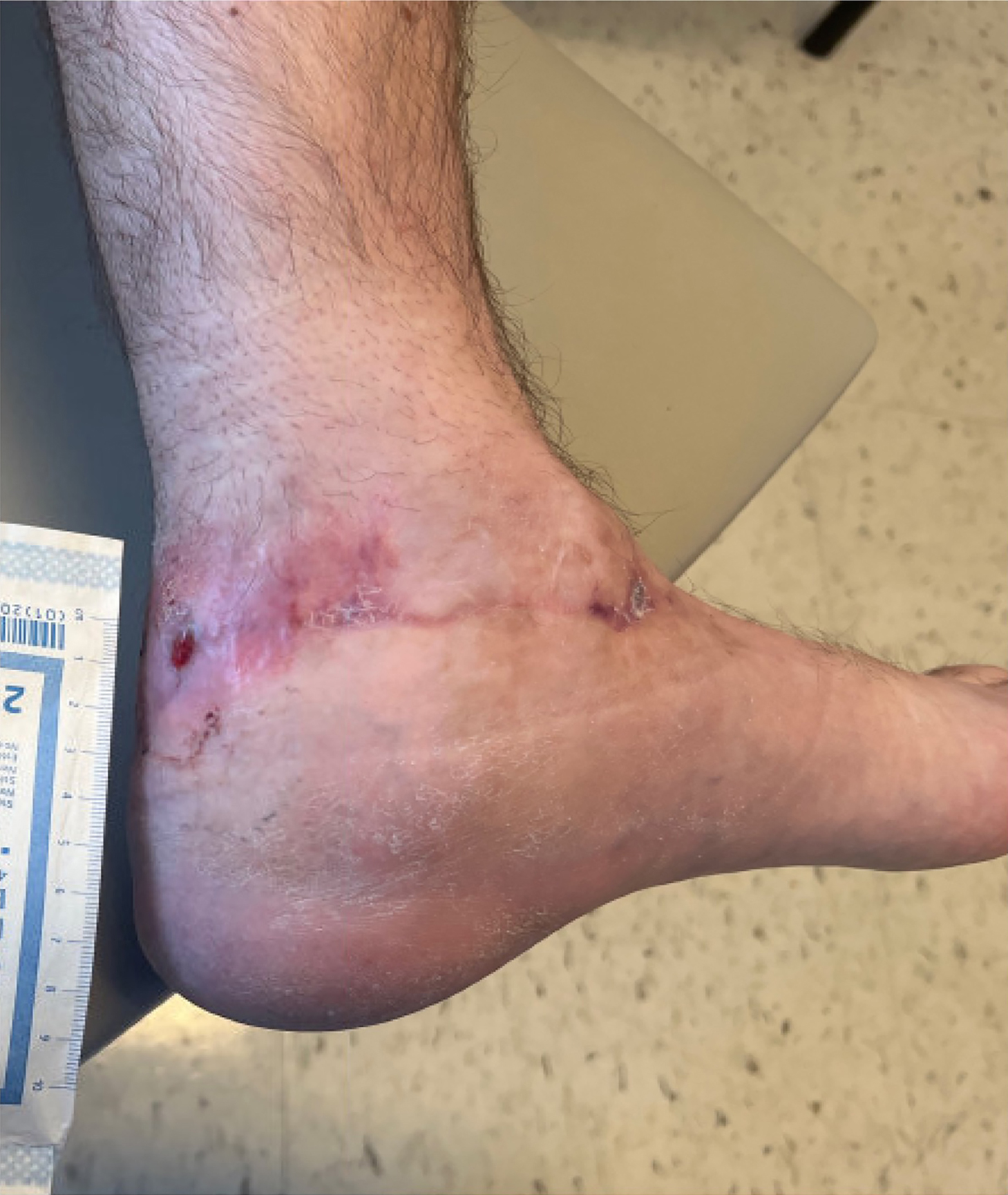 14 weeks postop - almost complete closure​