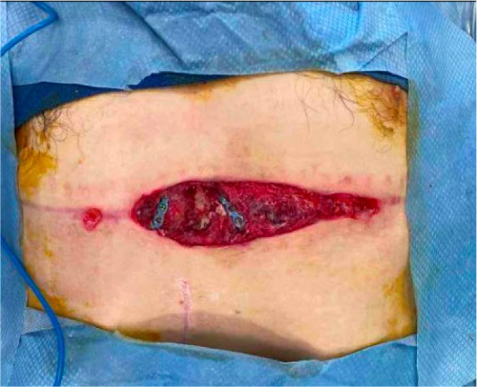 1 month post ORIF of sternum and complex chest wall closure, incision not closed