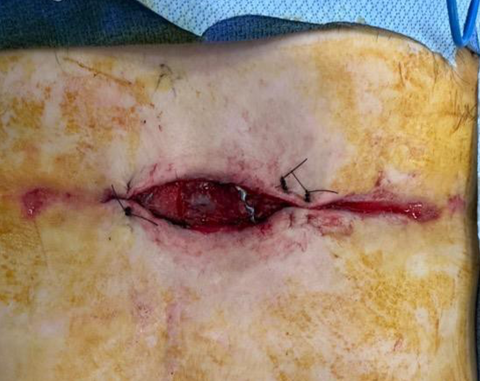 Creation of skin flaps, one GRAFIX membrane and one STRAVIX tissue placed, application of NPWT.