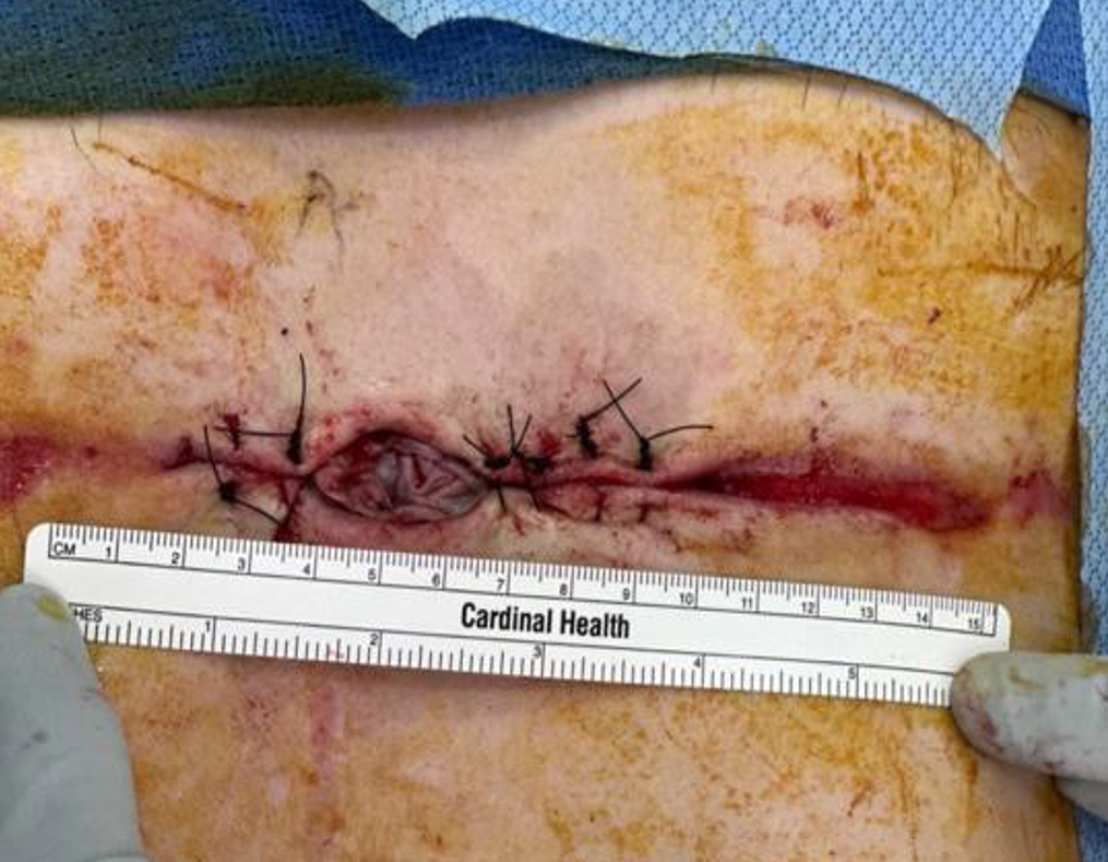 Creation of skin flaps, one GRAFIX membrane and one STRAVIX tissue placed, application of NPWT.