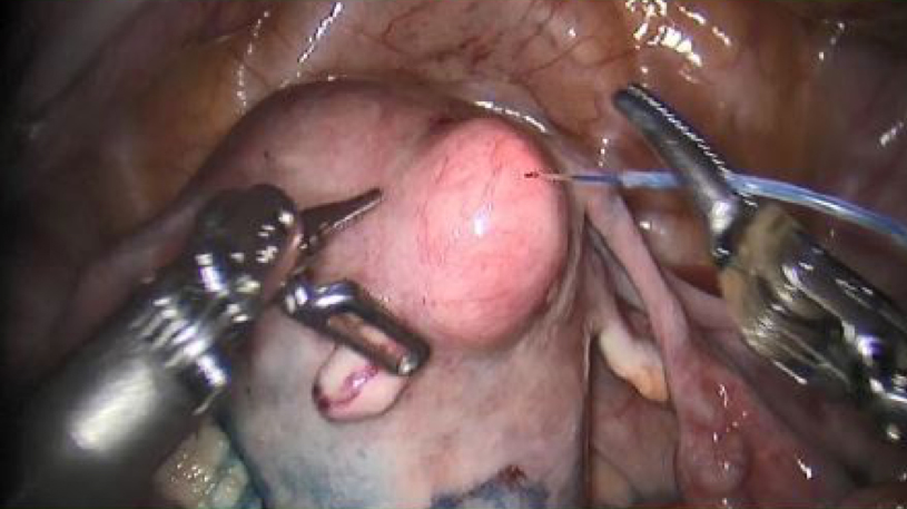 View of myoma during robot-assisted laparoscopic myomectomy