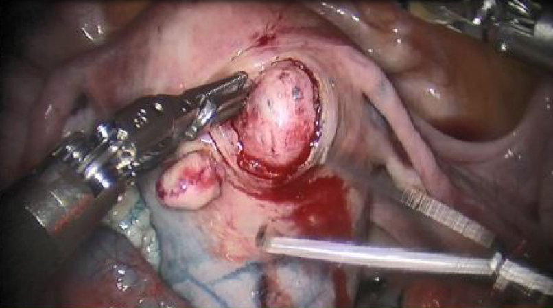 Dissection and removal of myoma