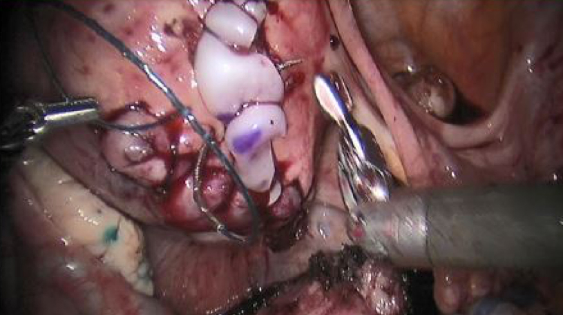 STRAVIX Tissue placed into tissue deficit and secured with sutures