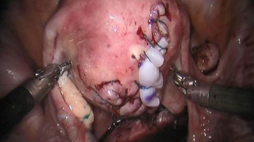 Final view of STRAVIX Tissue also being used as a barrier