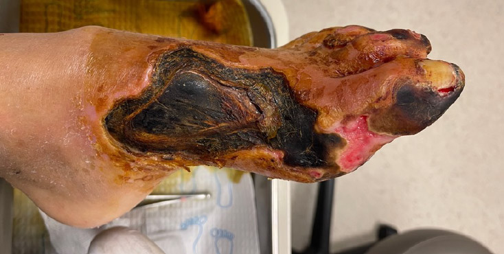 Initial presentation prior to vascular intervention