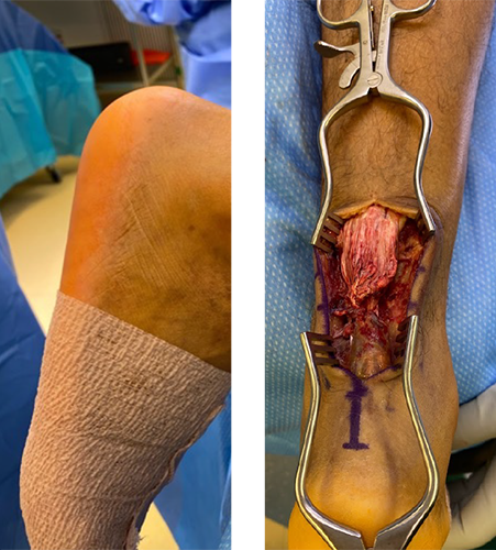 Acute Achiles tendon repair