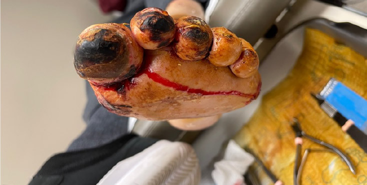 Initial presentation prior to vascular intervention