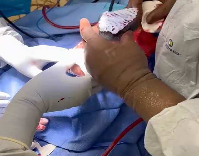 Two STRAVIX meshed tissue 6” x 3”