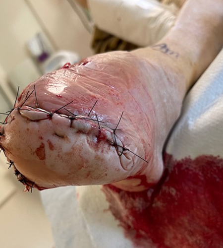 POST-OP Day #4-Rapid granulation