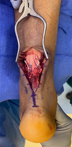 Achilles tendon end to end repair