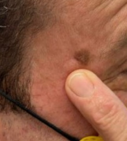 Pre-OP - presentation