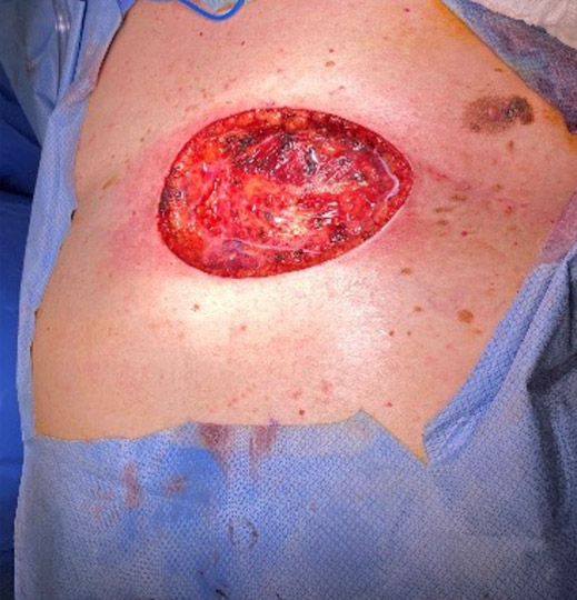 Intra-OP 10 x 15 x 3cm