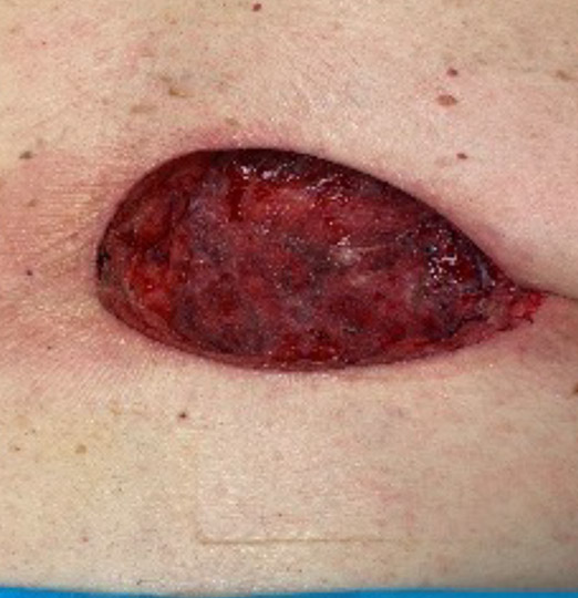 1-week post-op 9 x 13.5 x 2cm