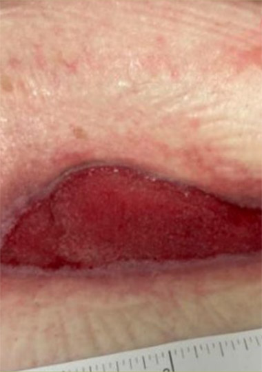 6-week post-op 3 x 8 x 0cm