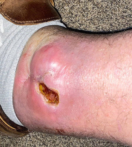 3 months Post Total Ankle Replacement