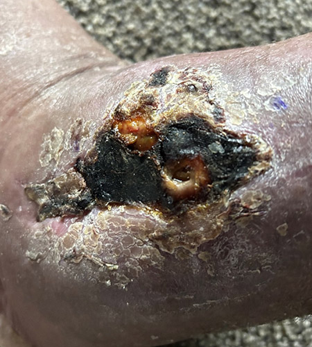 Pre-op eventual skin necrosis