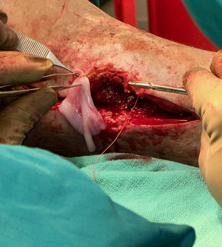 Intra-op: TAR removed, STRAVIX Tissue applied over fusion