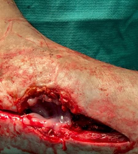 Intra-op: STRAVIX affixed with 3-0 Coated VICRYLTM