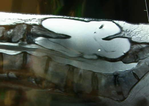 MRI with CSF collection