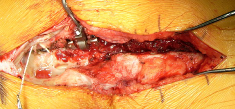 Complete excision and hardware replacement