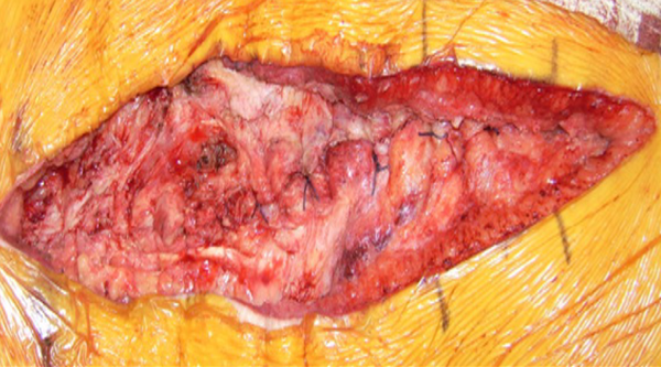 Muscle flap closure